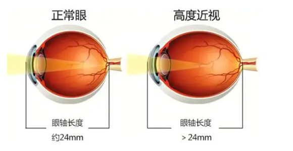 高度近视