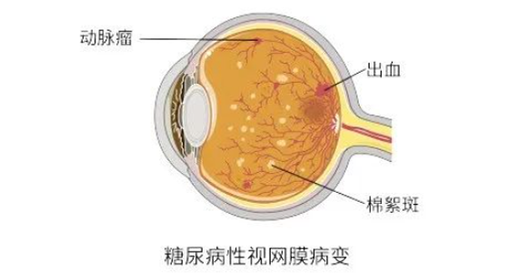 糖尿病眼底病变治疗